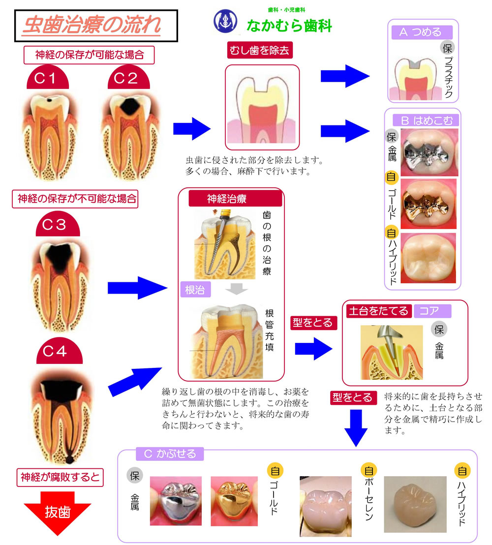 虫歯治療の流れ1